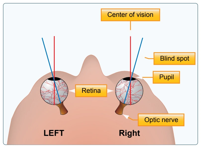 Central blind spot.